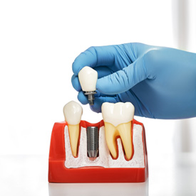 a model of dental implants